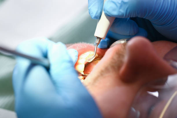 Best Emergency Tooth Extraction in Brownstown, IN