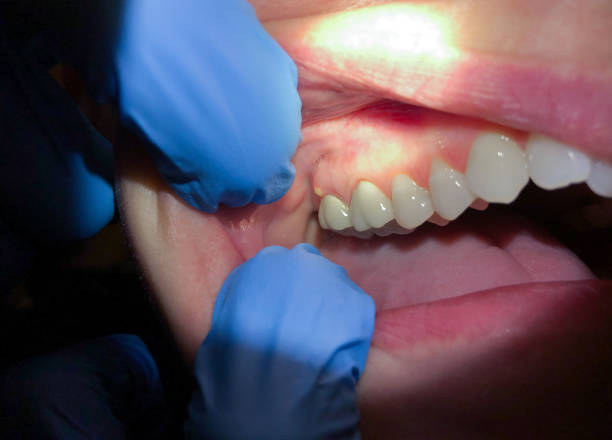 Best Emergency Treatment for Toothache in Brownstown, IN