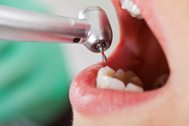 Best Emergency Tooth Extraction in Brownstown, IN